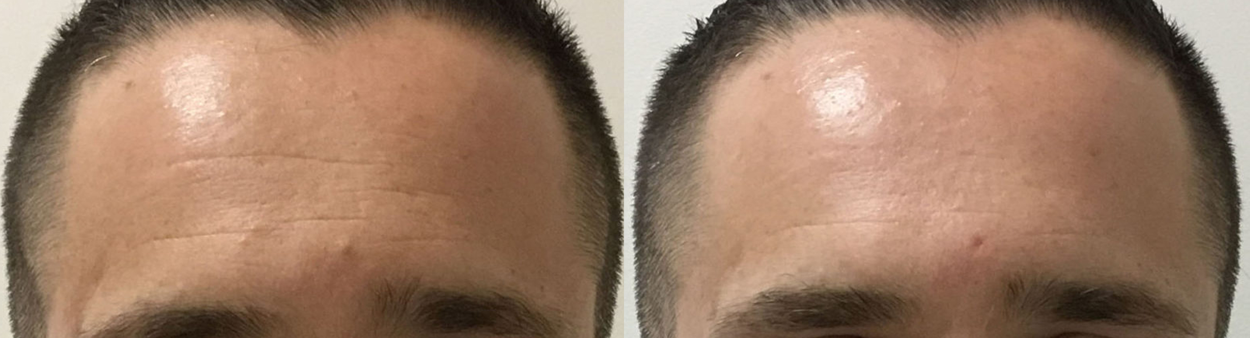 Botox Before and After Photo by Dr. Alessi in White Plains, NY