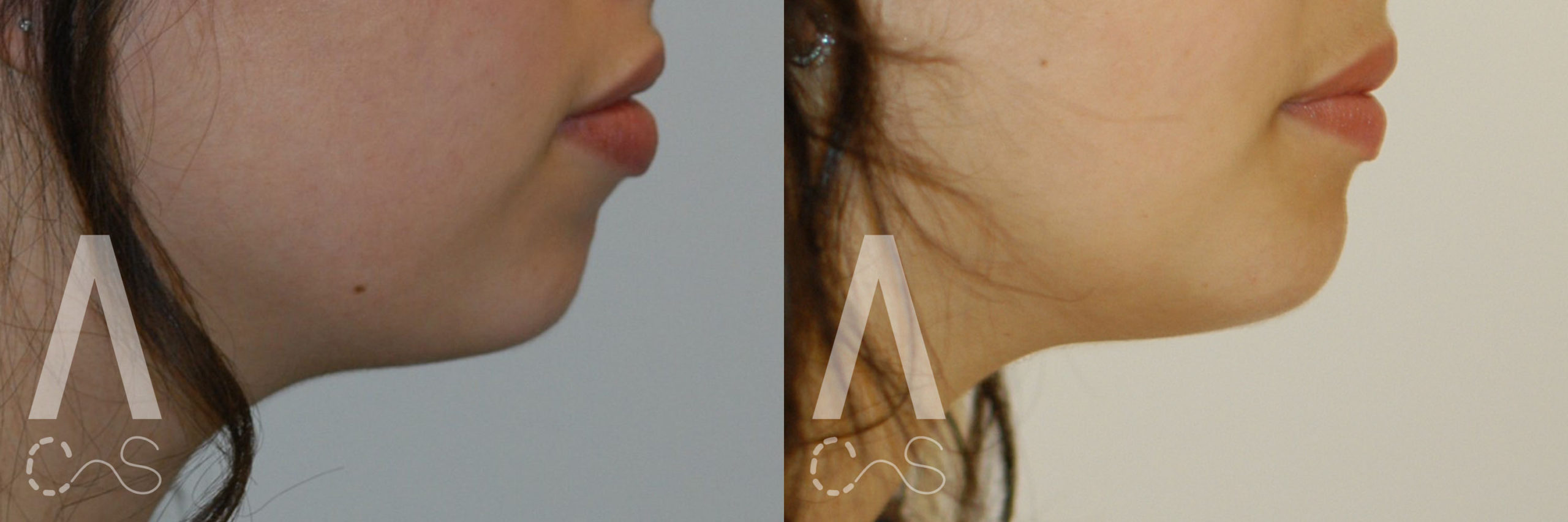 Chin Implant Before and After Photo by Dr. Alessi in White Plains, NY