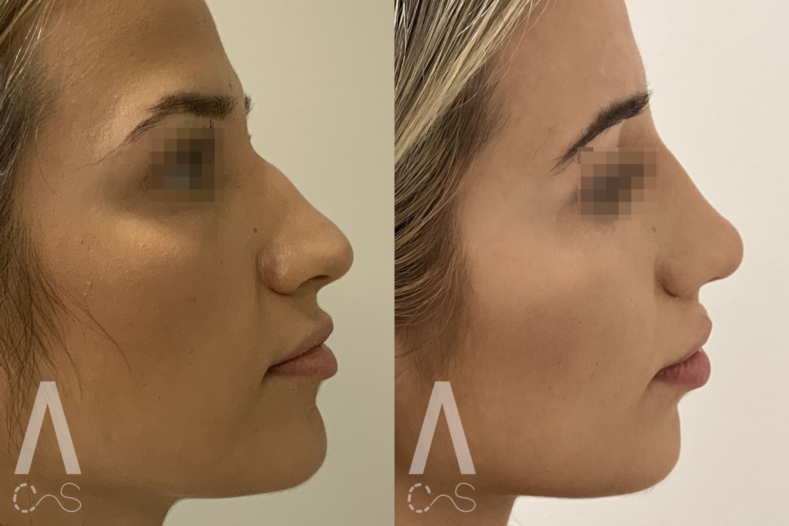 Lip Filler and Liquid Rhinoplasty Before and After Photo by Dr. Alessi in White Plains, NY