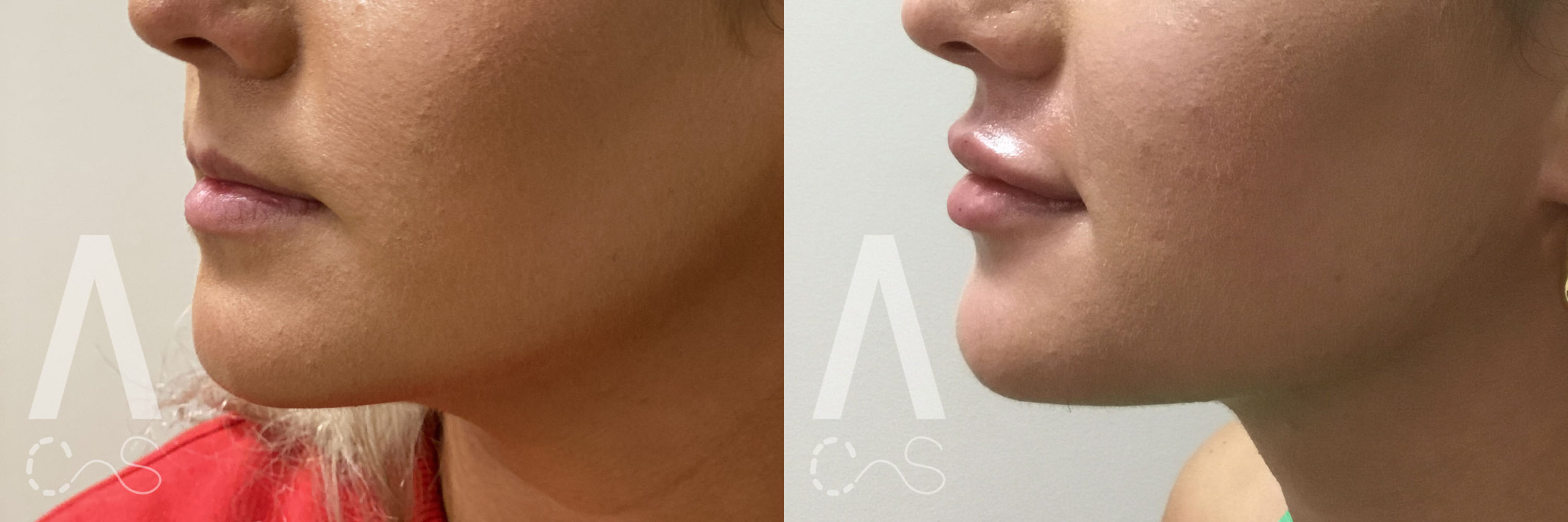Lip Fillers Before and After Photo by Dr. Alessi in White Plains, NY