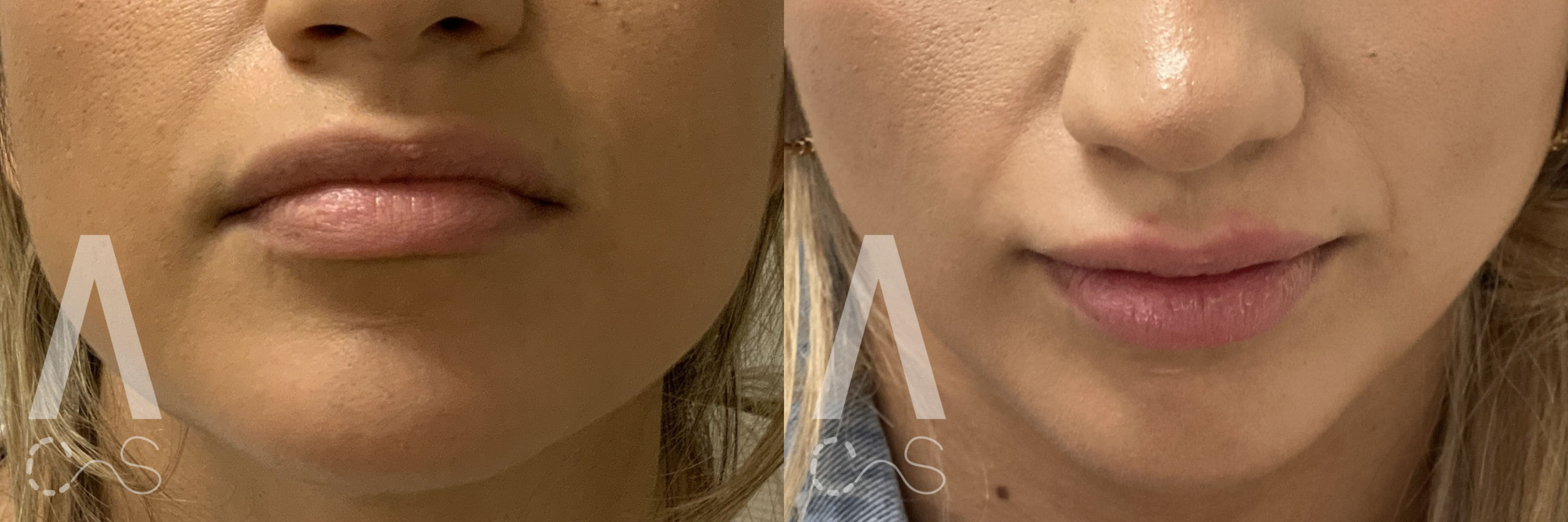 Lip Fillers Before and After Photo by Dr. Alessi in White Plains, NY