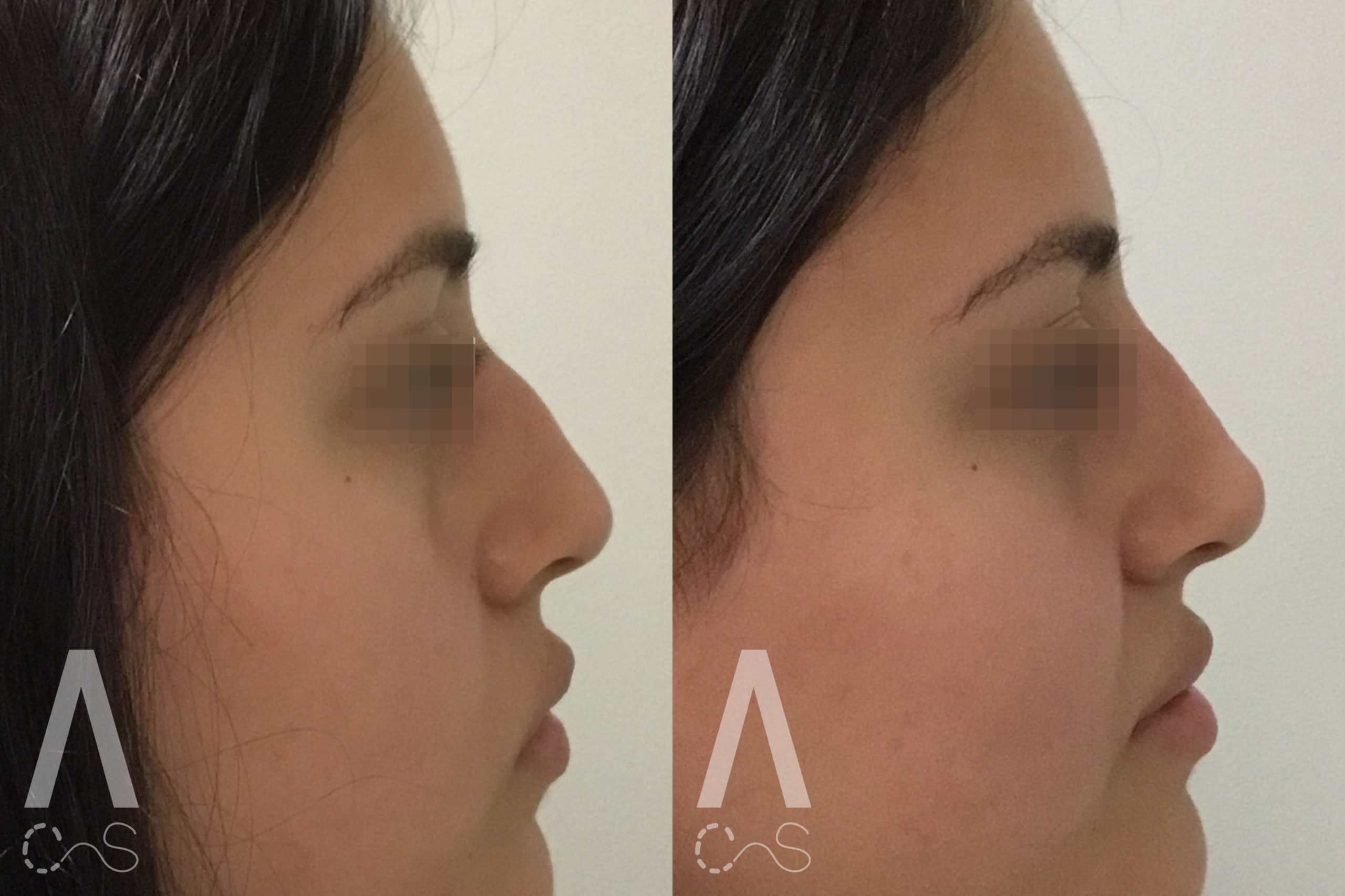 Liquid Rhinoplasty Before and After Photo by Dr. Alessi in White Plains, NY