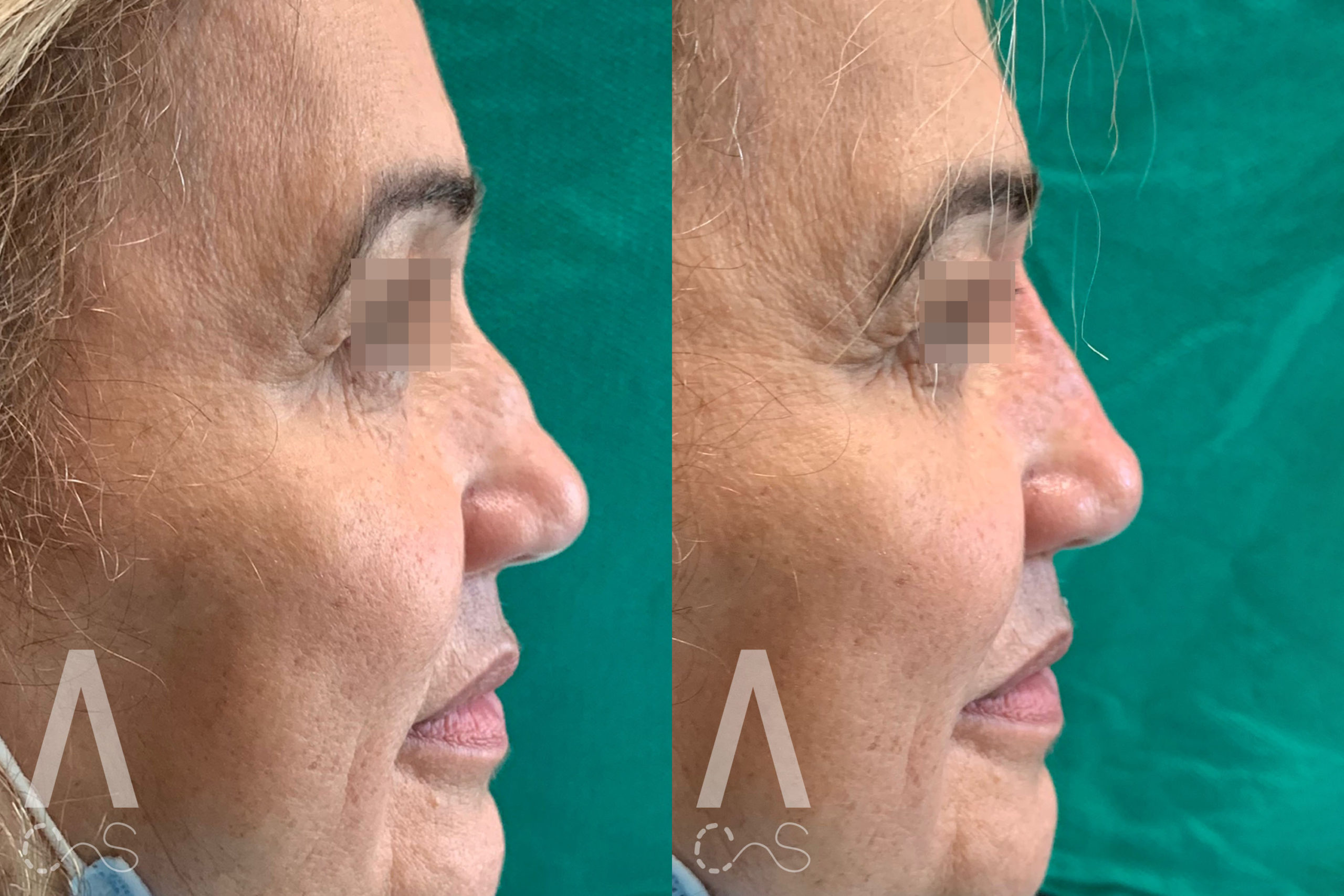 Liquid Rhinoplasty Before and After Photo by Dr. Alessi in White Plains, NY