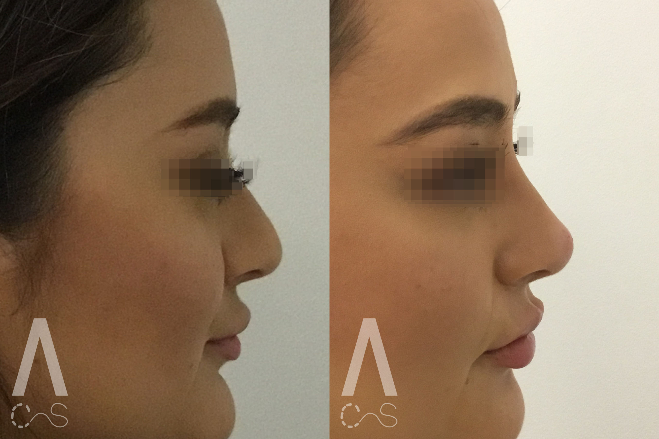 Liquid Rhinoplasty Before and After Photo by Dr. Alessi in White Plains, NY