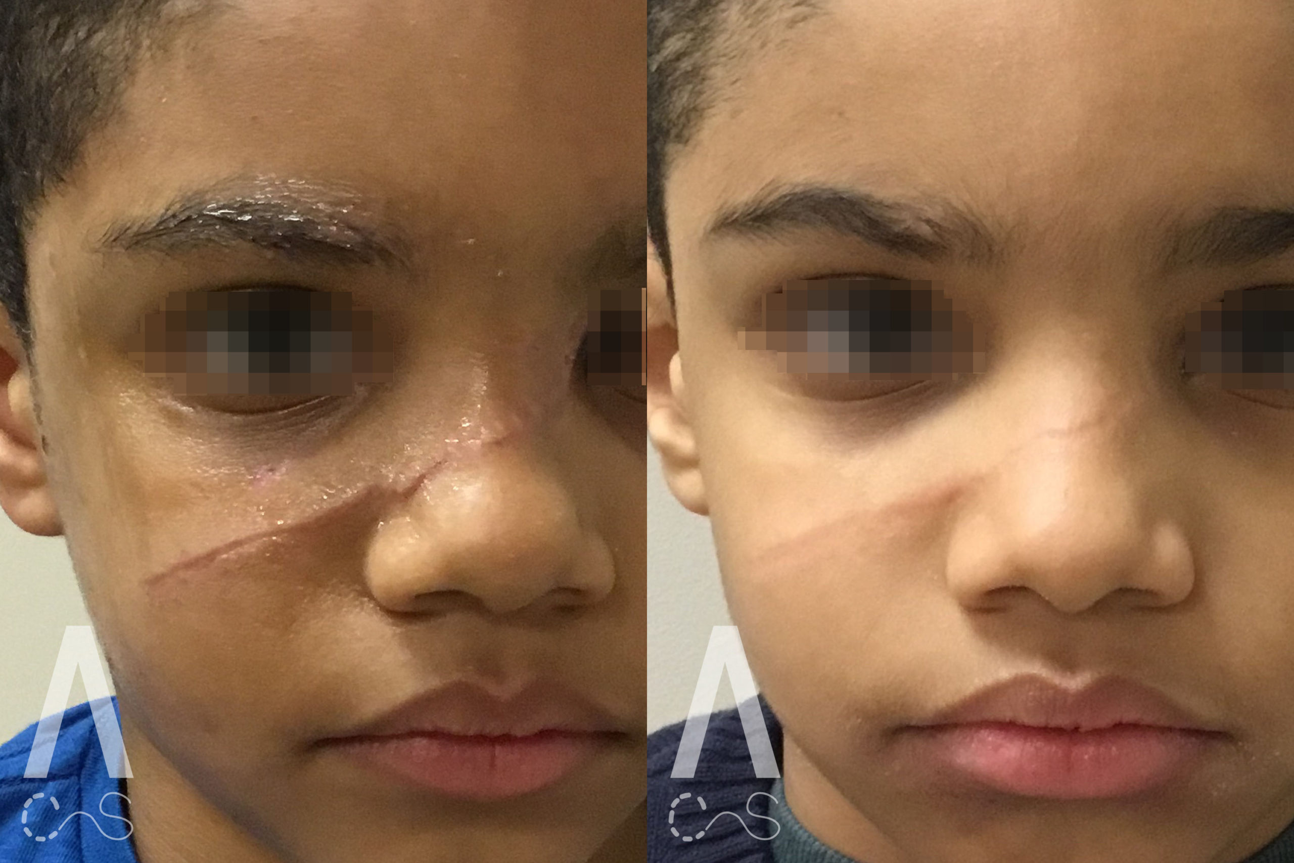 Scar Revision Before and After Photo by Dr. Alessi in White Plains, NY