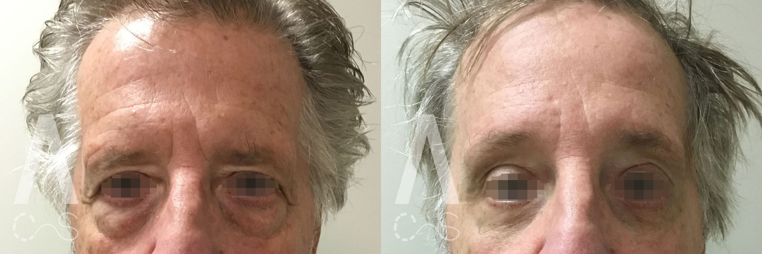 Endoscopic Brow Lift and Lower Blepharoplasty Before and After Photo by Dr. Alessi in White Plains, NY