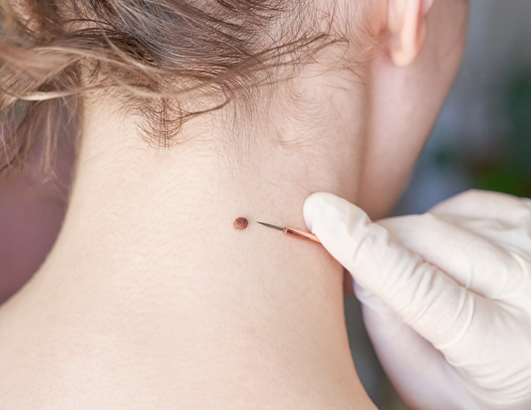 Woman examing her abnormal mole